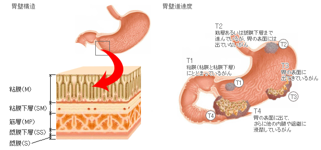 胃がん｜がん疾患を調べる｜がん情報サイト｜亀田メディカル